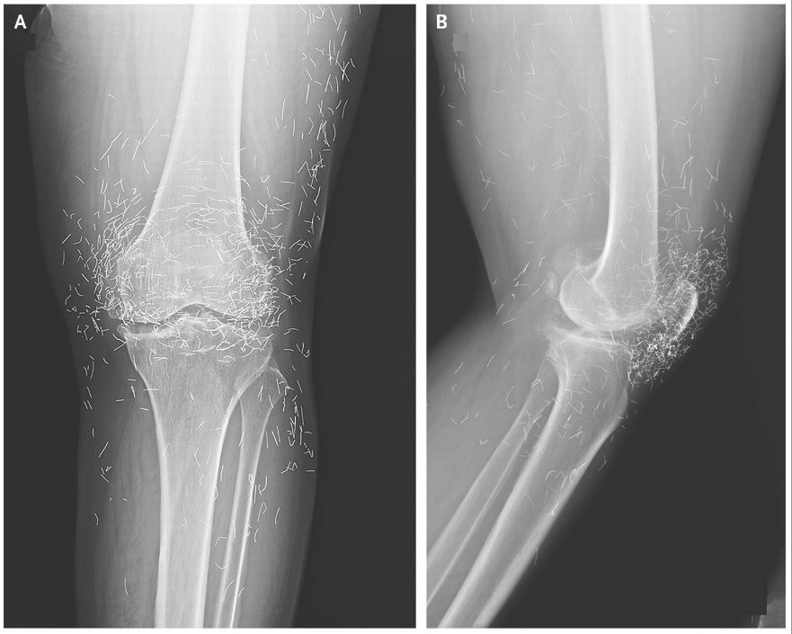 Diagnostic dilemma: Woman’s severe knee pain reveals ‘golden threads’ in her joints