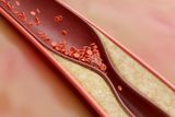More Effective and Safe Blood Thinning Drug May Soon Replace Low-Dose Aspirin
